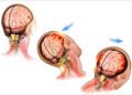 Brain Bleeding After a Head Injury: Symptoms You Should Never Ignore
