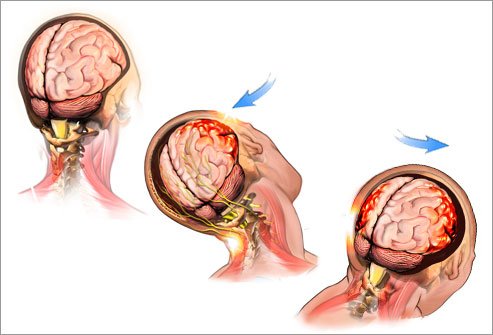 Brain Bleeding After a Head Injury: Symptoms You Should Never Ignore